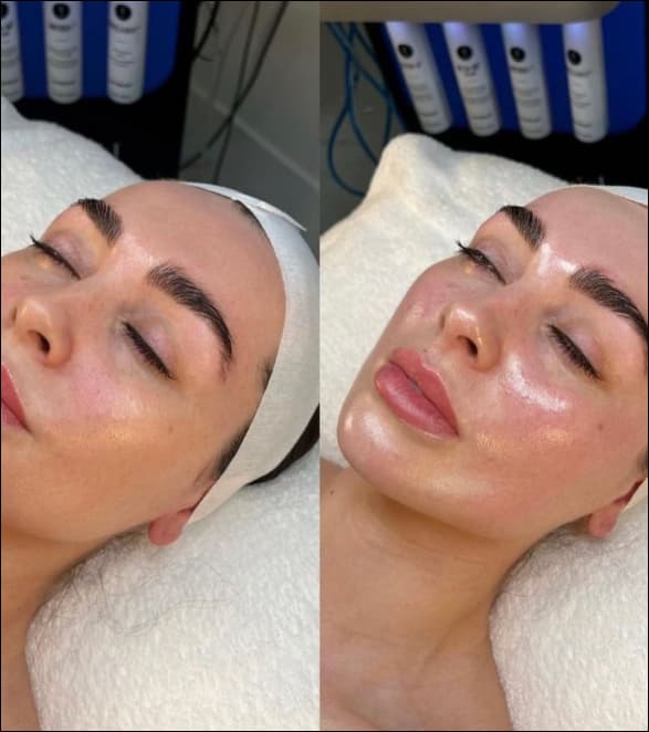 Hydrafacial Model